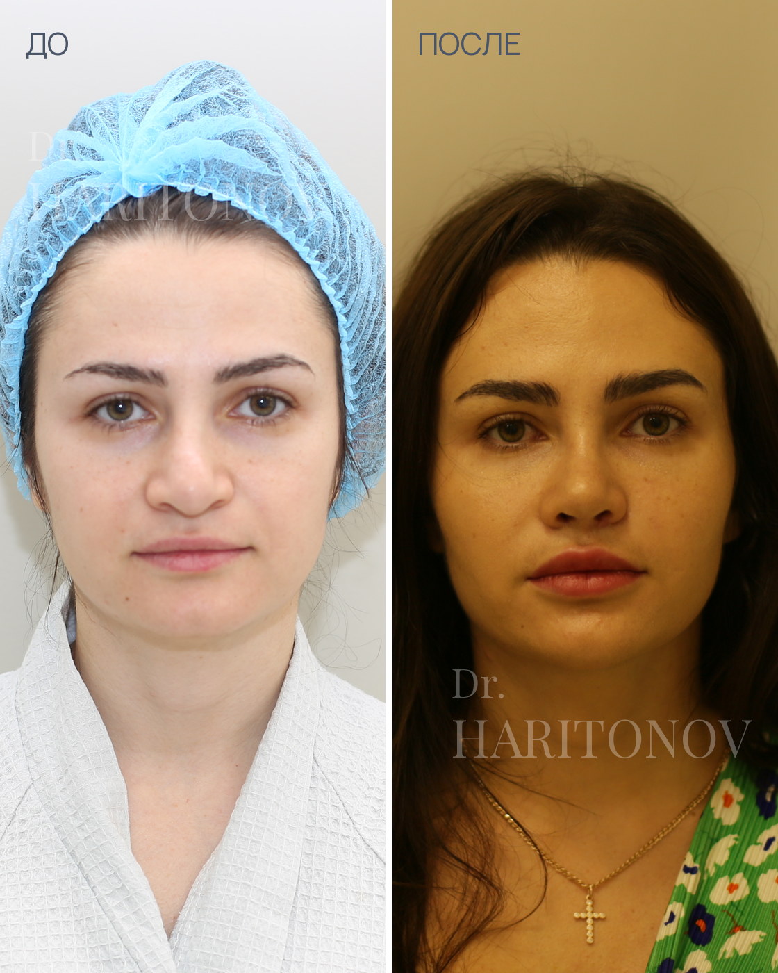 Пластика кончика носа — фото до и после, анфас