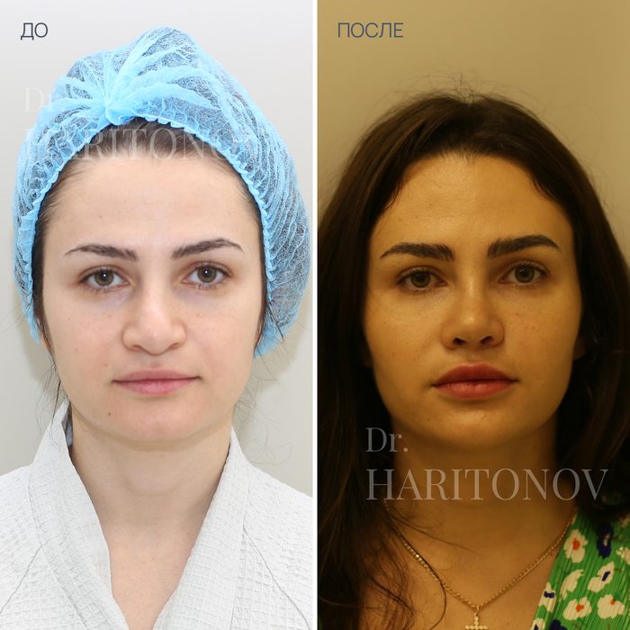 Пластика кончика носа — фото до и после, анфас