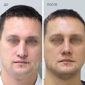 Посттравматическая ринопластика фото до и после 8
