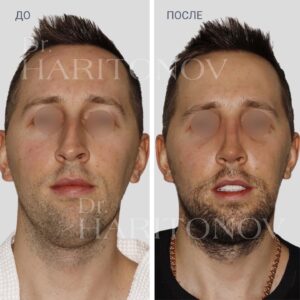 Мужская ринопластика фото до и после 16