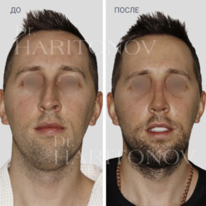 Мужская ринопластика фото до и после 2