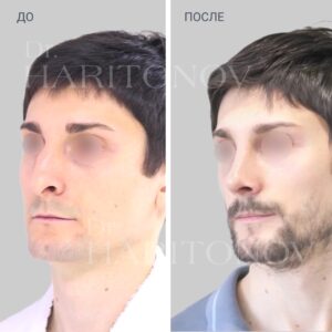 Мужская ринопластика фото до и после 3