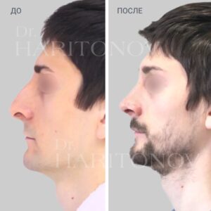 Мужская ринопластика фото до и после 4