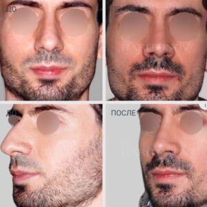 Мужская ринопластика фото до и после 6