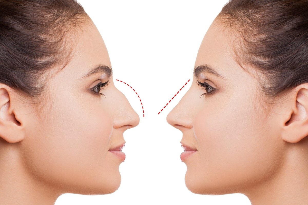 Что делать, если нос с горбинкой, а хочется прямой — рейтинг разных способов от эксперта